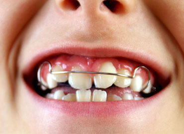 Neden Ortodontik Tedavi